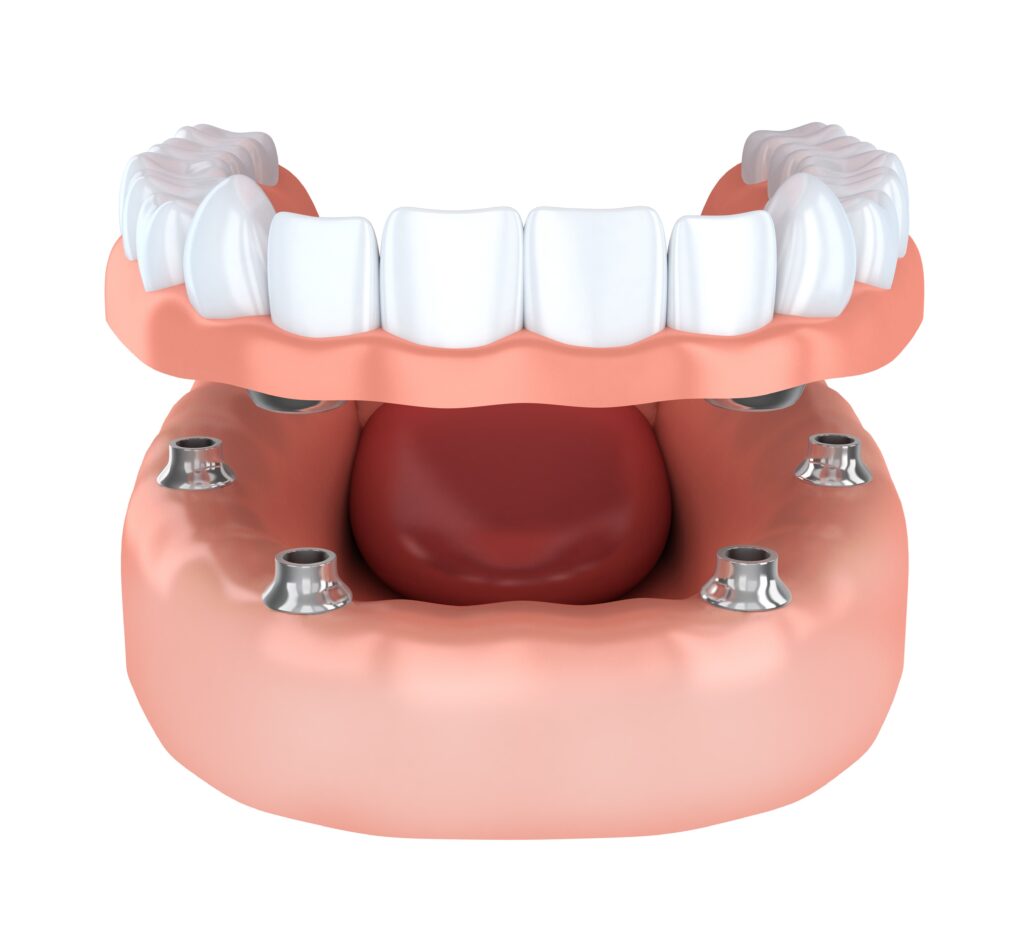 implant dentures in Kitchener