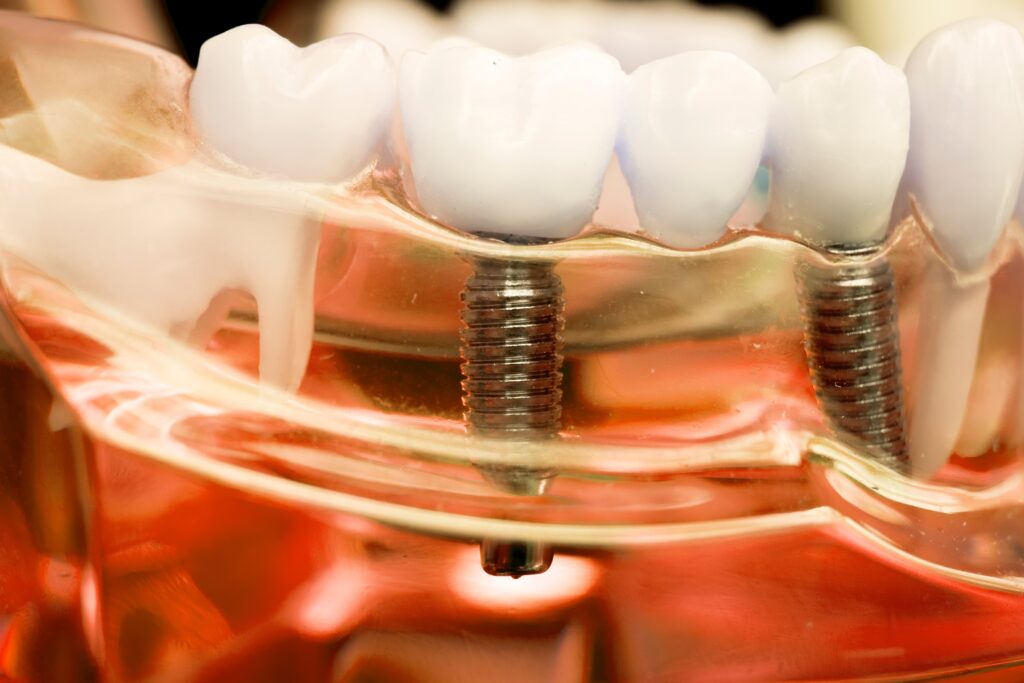 Dental Implants Things You Should Know Kitchener Dentist Kyle