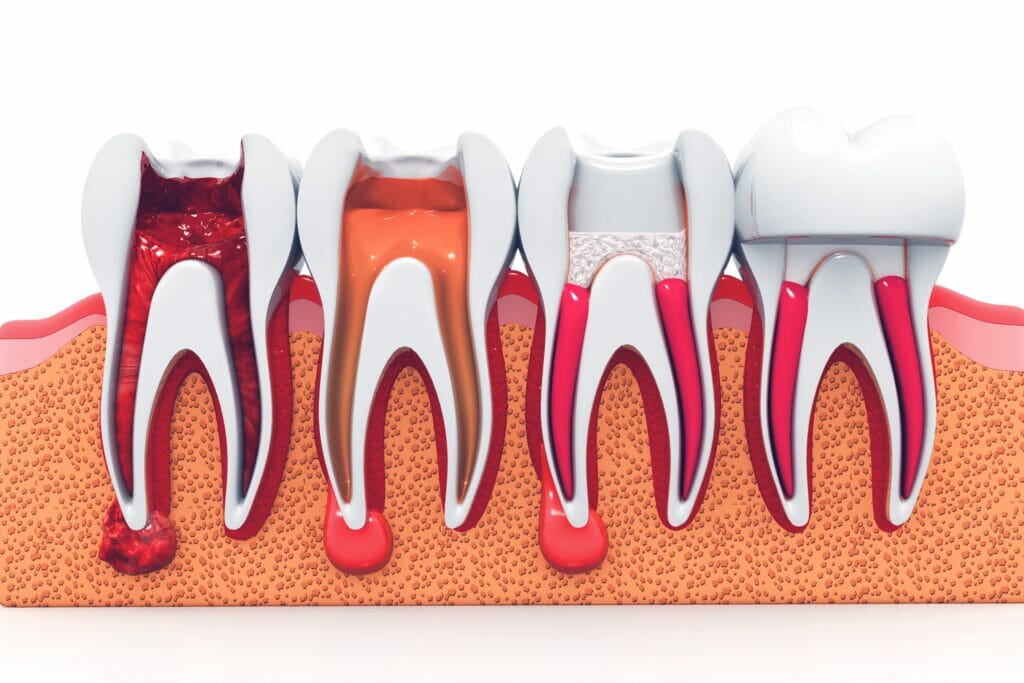 root canal by kitchener family dentist
