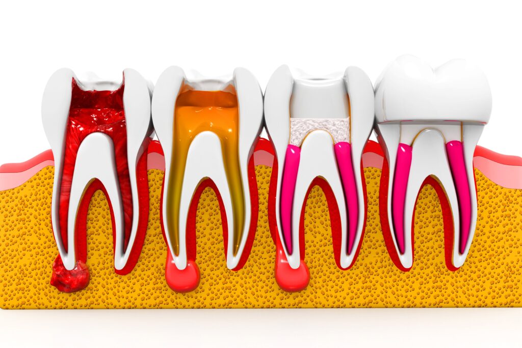 root canal near me
