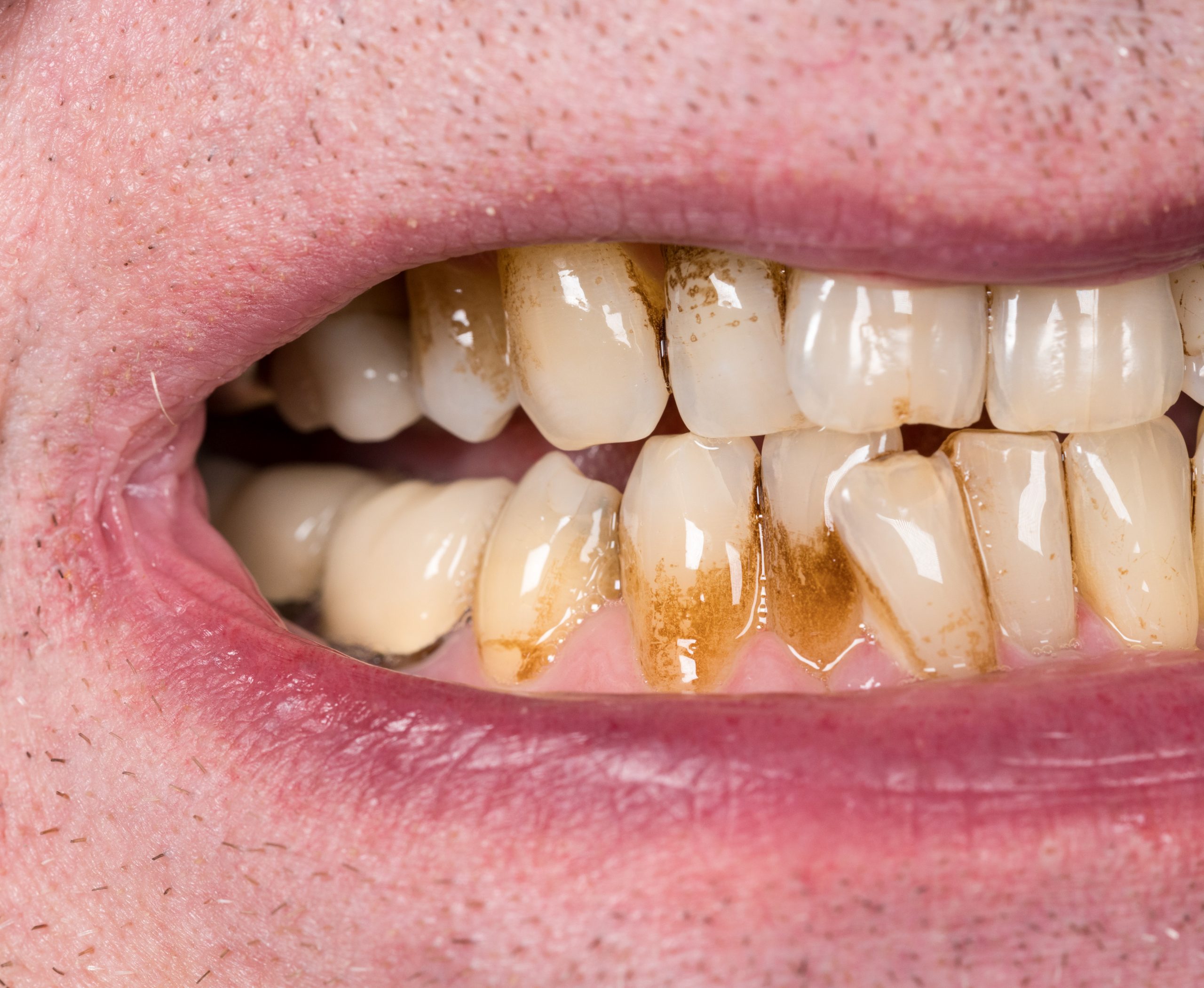 teeth are translucent and stained