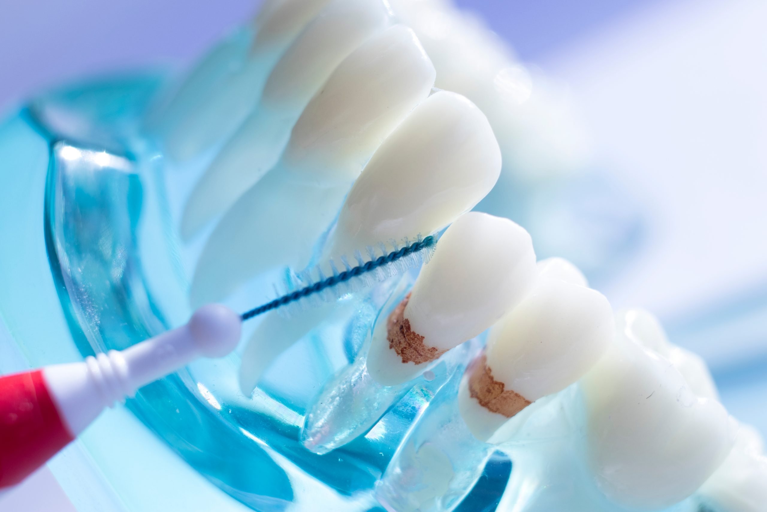 teeth traps between dental manage enamel cleaning