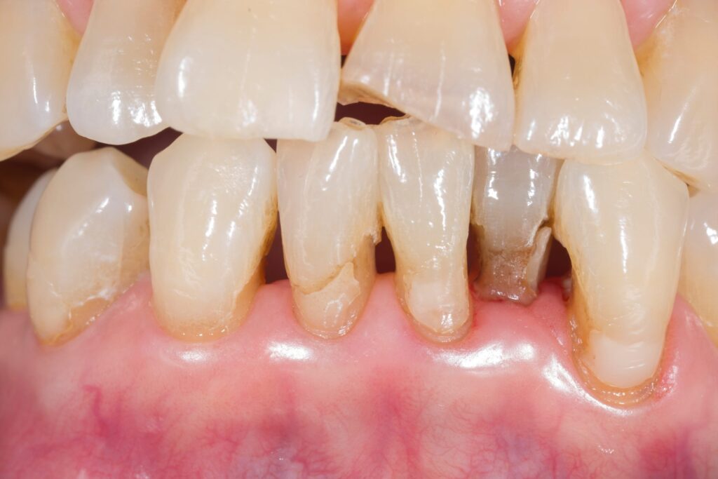 electric toothbrush causing gum recession