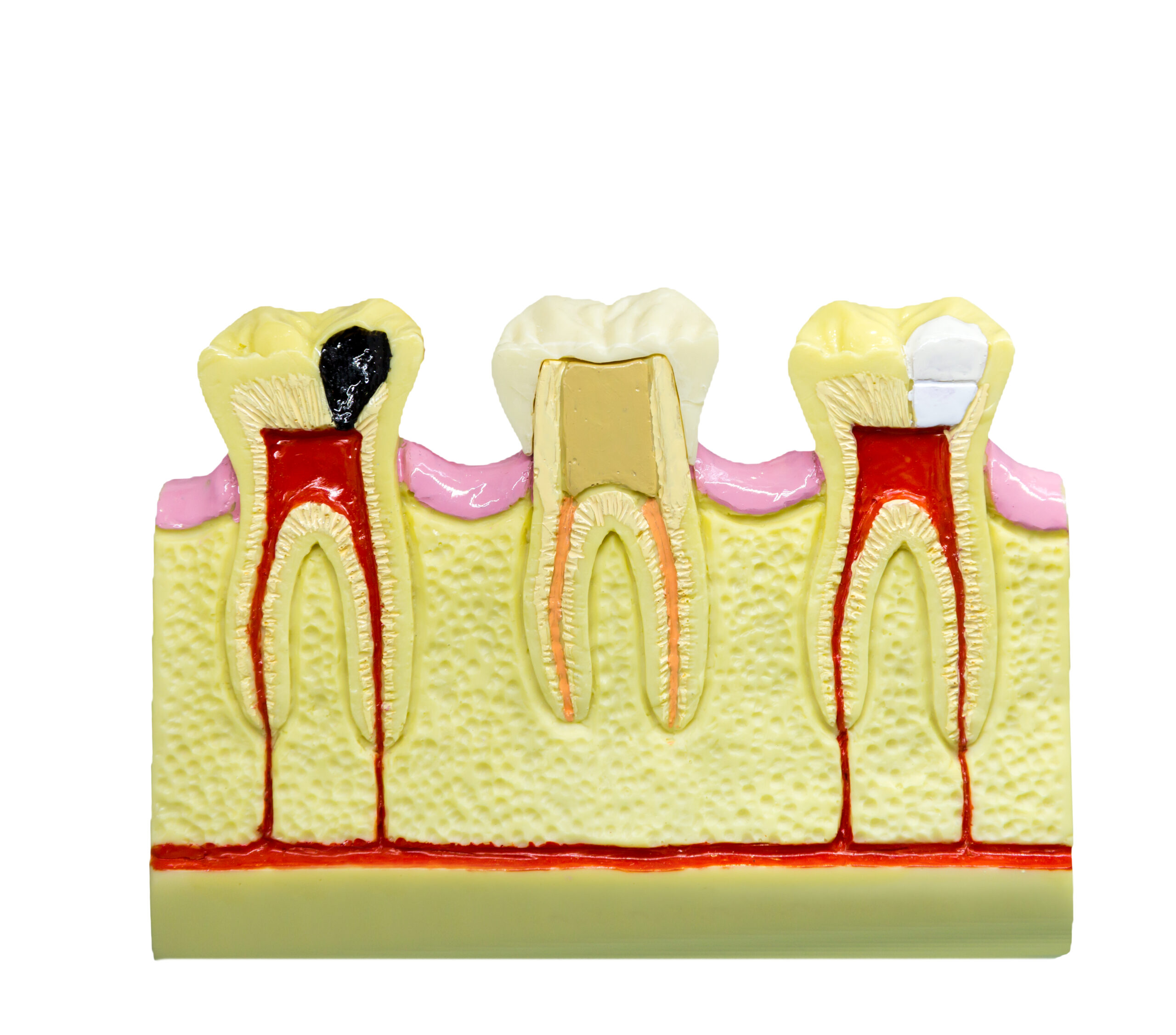 root-canal-treatment-the-10-most-frequently-asked-questions-enamel